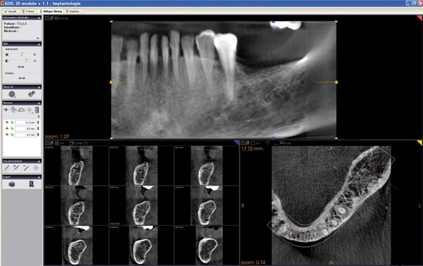 Obliq slicing implant Obliq slicing implant